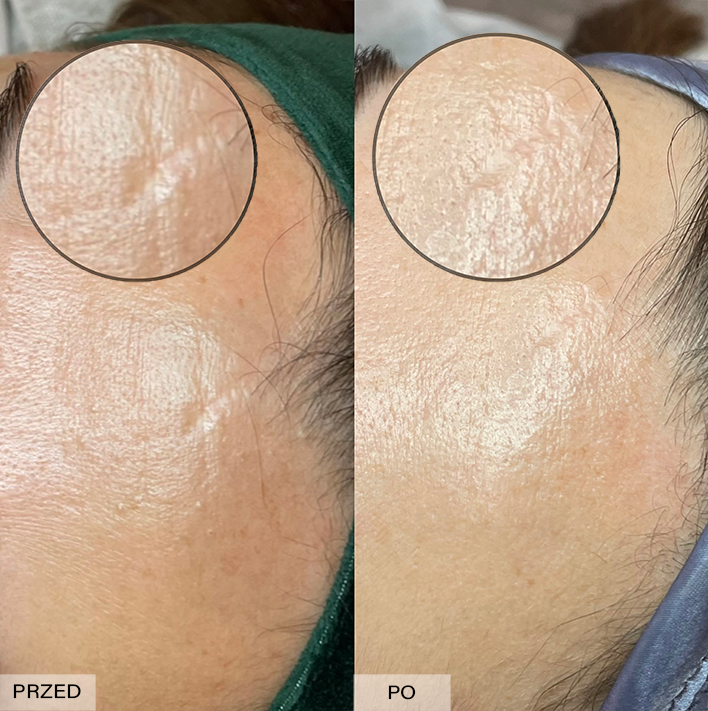 usuwanie blizn efekty